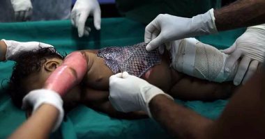 مفاجأة.. جلد السمك البلطى أحدث علاج للحروق الشديدة وتقليل آلامها