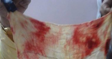 بالصور.. طبيب ينسى "الفوطة" فى بطن مريضة عقب إجراء عملية جراحية