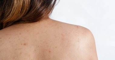 4 وصفات طبيعية لعلاج حب الشباب فى الظهر 