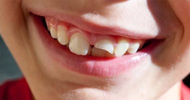 عشان ضحكتك هى عنوانك..العناية بالأسنان تحميكى من التآكل