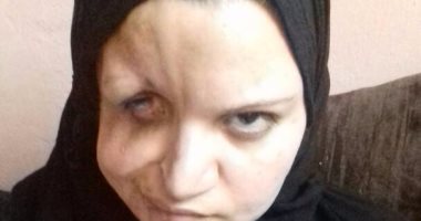 مأساة ربة منزل بالغربيه تعانى من مرض نادر وزوجها يناشد وزير الصحه علاجها