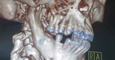 بالصور.. قارئ يطالب بمساعدته ماديا فى إجراء عمليات زراعة فك