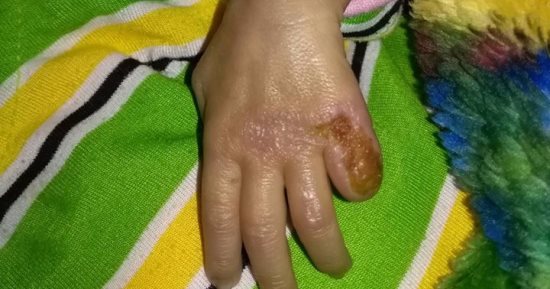 قارئ يرسل شكوى من مركز طبى بكفر الشيخ عن حرق يدها والإصابة بعجز فى الحضانة