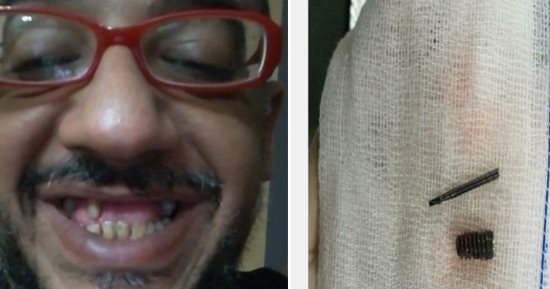 بالصور والأشعة.. جراح أسنان يدخل مسمارا فى الجيوب الأنفية لمريض خلال عملية زرع وعند محاولة إبعادها يترك إحدى المعدات داخل اللثة.. والضحية: "ركبوا لى أسنان مؤقتة بعد فشلهم" ونزفت 12 ساعة دون رعاية