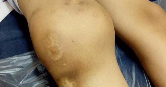 أم تطلب مساعدة نجلها بعد إعوجاج ركبته نتيجة حادث توكتوك أدى لتمزق الأربطة