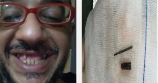 مريض المسمار مؤمن المحمدى: أخضع لعملية جيوب أنفية 6 ساعات بسبب خطأ طبى