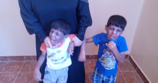 مرض جلدى نادر يصيب طفلين توأم بالشرقية وأسرتهما تناشد المساعدة فى علاجهما