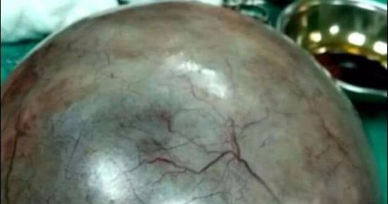 طبيب بالقليوبية يستأصل كيسا دمويا على المبيض لمريضة يزن أكثر من 5 كيلوجرامات