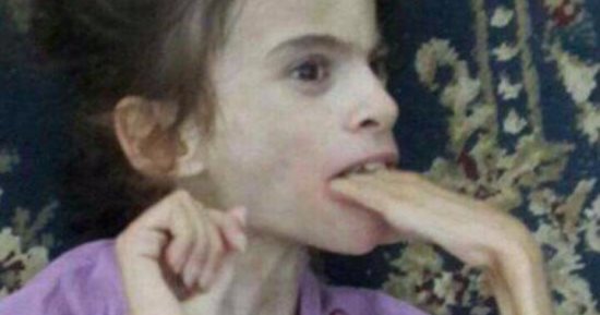 هبة تتحول لهيكل عظمى ووالدتها تستنجد بمجلس الوزراء "بعنا عفش البيت"