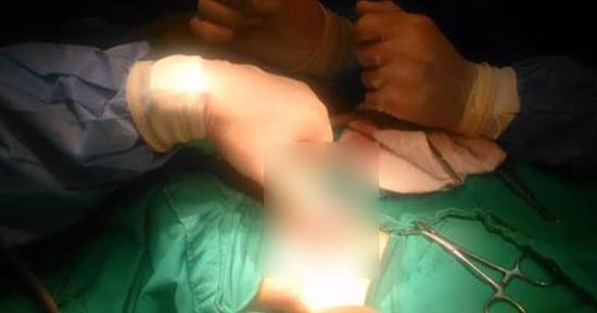 إجراء أول جراحة بالقولون لطفل عمره أسبوعان بـ"مبرة طنطا"