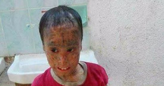  بعد انتشار صورة الطفل المصاب بمرض قشرة سمكة.. هانى الناظر يعلن مساعدته