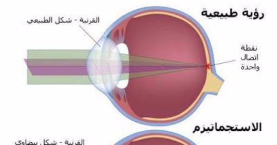طبيبة عيون: "الإستيجماتيزم" المنتظم يمكن علاجه بالعدسات 