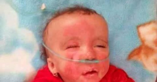 بالصور.. احتراق وجه طفلة رضيعة فى جلسة تنفس صناعى بمستشفى كفر الشيخ