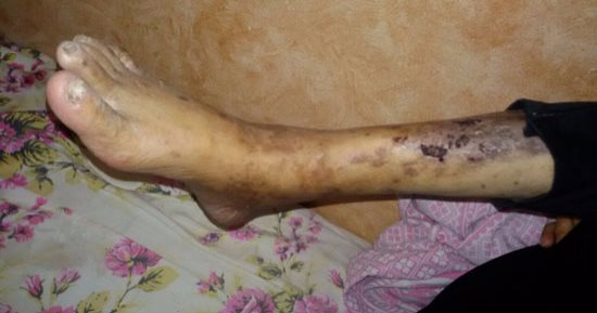 بالصور ..مواطن مديون بـ 70 ألف جنيه ويحتاج إجراء عملية لانقاذه من بتر قدمه 