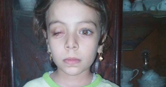 مادة كيميائية أفقدت الطفلة "نور" بصرها.. ووالدها يطالب بعلاجها