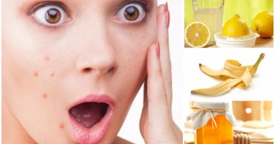 بدل ما ترميه.. استخدمى قشر الموز للتخلص من حب الشباب فى 3 وصفات 