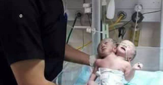 ولادة طفلين توأم برأسين وجسد واحد فى قطاع غزة