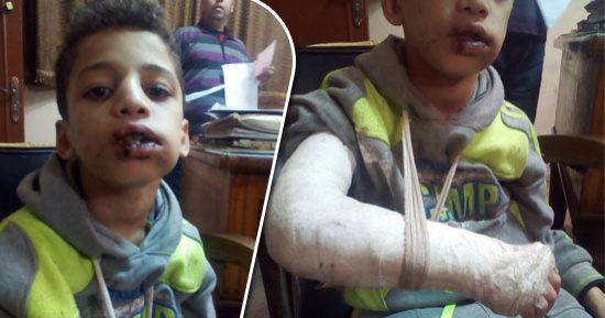أب يعذب طفليه ويصيبهما بكسور وجروح بحجة تأديبهما بالسنطة "صور" 