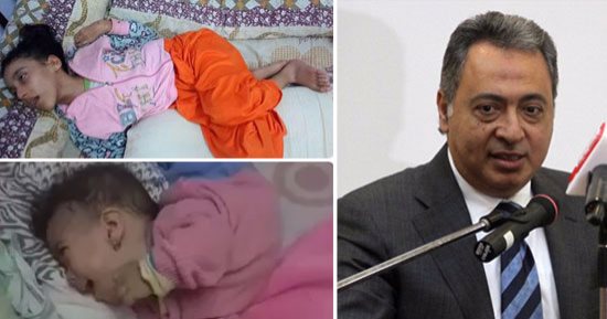 "شهد و روان" مأساة أسرة تحت خط الفقر.. الابنة الكبرى مصابة بضمور فى المخ.. والصغرى مصابة بمرض نادر تسبب فى التواء رقبتها وعمودها الفقرى.. والأم: "نفسى حتى تفرد جسمها".. وتطلب من وزارة الصحة علاج طفلتيها