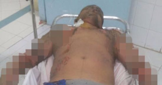 مواطن بالشرقية يحتجر شابا معاق ذهنيا بمنزله ويوثقه بالحبال ويشعل النيران بجسمه