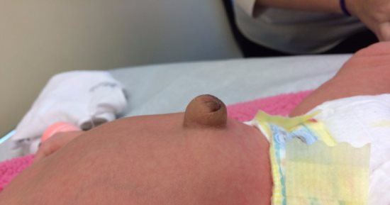 الفتق الإربى.. أسبابه وأعراضه وعلاجه