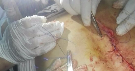 استئصال طحال طالب وإصابته بنزيف بعد طعنه على يد زميله فى مدرسة بالدقهلية
