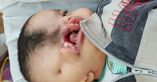 صور.. طفل يعانى من مرض نادر يحتاج لعلاج خارج مصر