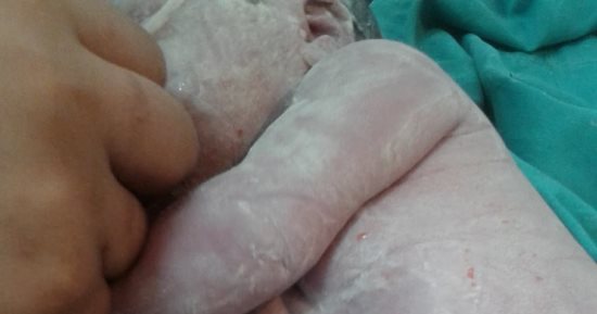 مأسأة رضيعة أمعاءها وكبدها خارج جسدها بالسويس.. و40 ألف جنيه تنقذ حياتها