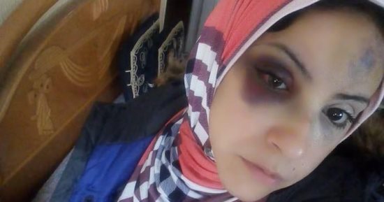 "إسراء".. هربت من الإهانة بالطلاق فتلقت علقة موت شوهت وجهها.. صور