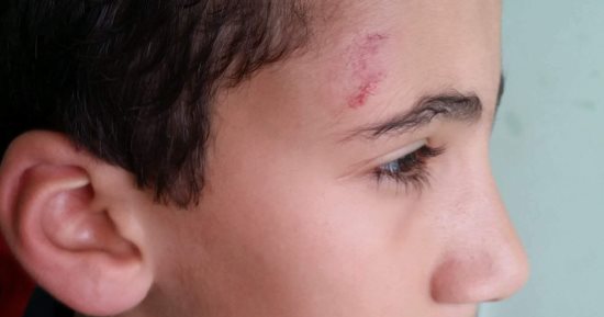 إصابة تلميذ ابتدائى بـ"طوبة" فى مدرسة بالشرقية ويحتاج لجراحة بـ15ألف جنيه