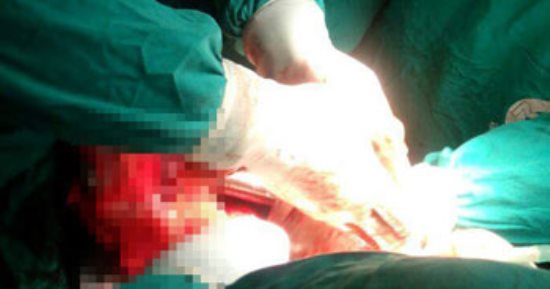 صور.. استئصال غدة درقية ضخمة من صدر مريضة بجامعة المنصورة