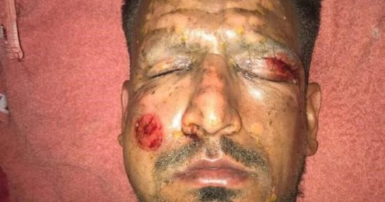 شاهد.. مهاجم بنيارول الأرجنتينى ينشر صورته بعد التعافى من إصابة الصواريخ