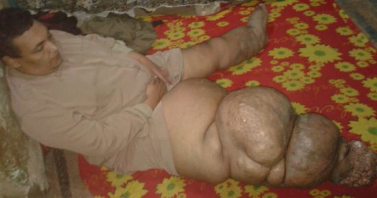 صور.. محمود مصاب بداء الفيل: مش عارف أنام وعلاجى بـ35 ألف جنيه ونفسى أتعالج