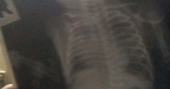"سلمى" طفلة عمرها 20 يوما تعانى من ثقبين فى القلب وتحتاج جراحة عاجلة