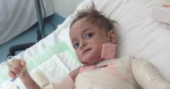 صور.. مأساة شقيقين بكفر الشيخ يعانيان من نزيف مستمر لنقص الهيموجلويين