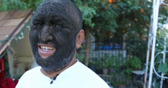  الرجل الذئب.. أمريكي يصاب بمرض نادر يغطى جسمه بالشعر بنسبة 98%