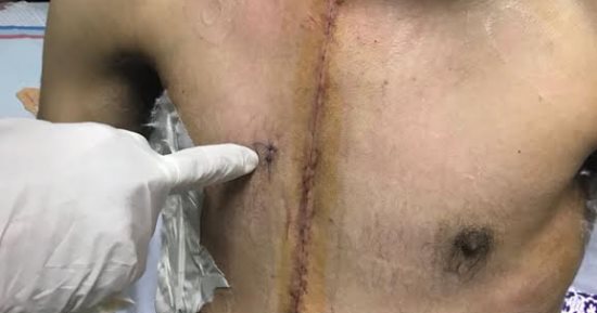 خلال ساعة واحدة.. إنقاذ مصاب بطعنة فى القلب بعد إجراء جراحة له بطوارئ المنصورة