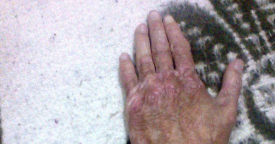صور.. قارئ مصاب بمرض جلدى يستغيث: "ما حدش راضى يشغلنى وأنا محتاج أدوية"