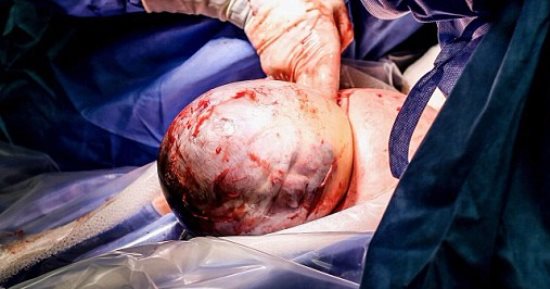 ديلى ميل: ولادة طفلة أمريكية بداخل كيس الغشاء الأمنيوسى فى حالة نادرة.. صور