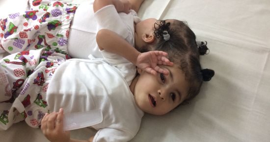 صور.. جامعة المنصورة تستجيب لطلب والد بفصل طفلتيه الملتصقتين من الرأس