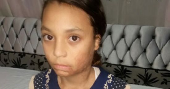 صور.. الطفلة تيسير بالشرقية تعانى من أزمة نفسية بعد تعرضها لحريق بنزين 