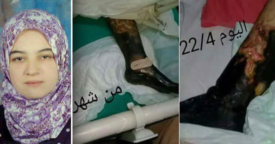 انقذوا نهاد.. مأساة فتاة مهددة ببتر قدميها والعلاج فى الخارج الأمل الوحيد