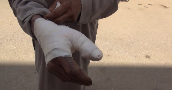  إصابة سائق بحروق أثناء وضعه بنزين داخل "توك توك" بالبحيرة
