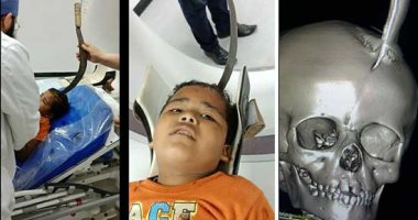 صور.. أطباء مصر يواصلون صنع المستحيل.. بعد إنقاذ طفل السيخ بطنطا.. أطباء كفر سعد بدمياط ينقذون طفل المنجل.. الأم: كان بيلعب فسقط على منجل واستقر فى رأسه.. ومدير المستشفى: أصيب بنزيف فى الجمجمة وحالته مستقرة