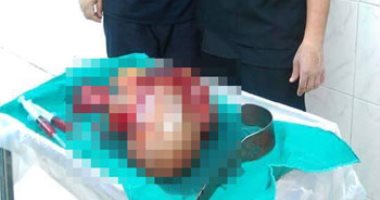 استئصال ورم يزن 12 كيلو بمبيض سيدة فى مركز أورام طنطا