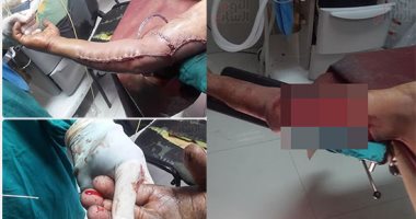 صور.. أطباء مستشفى دمياط التخصصى ينقذون ذراع عامل تعرضت للهرس خلال تنظيفه ماكينة أخشاب.. الطبيب المعالج: الجراحة استمرت 4 ساعات ونصف لتثبيت الذراع وتوصيل الشرايين واستعادة الدورة الدموية وحالة المريض مستقرة