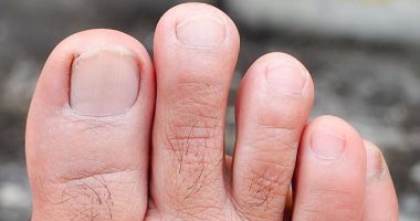 ارتفاع درجات الحرارة يؤدى إلى زيادة حالات العدوى الفطرية.. طرق لحماية نفسك