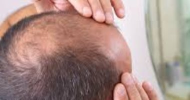 بالعسل والبصل.. 4 وصفات منزلية لعلاج الصلع 
