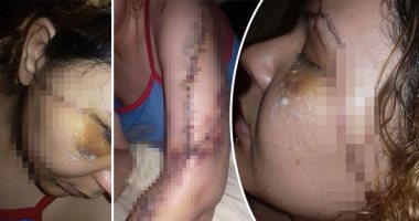 صور.. رحاب حاولت الهروب من جحيم الخلافات الزوجية بالقانون فكان عقابها 200 غرزة.. زوج المجنى عليها مزق جسدها بمطواة بعد رفعها دعوى خلع.. ونيابة طنطا تأمر بضبطه وإحضاره