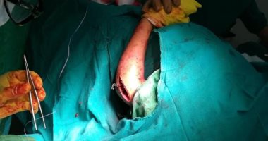 صور.. ﻷول مرة إجراء جراحة إصلاح تشوهات عظام اﻷطفال بمستشفى أبورديس المركزى